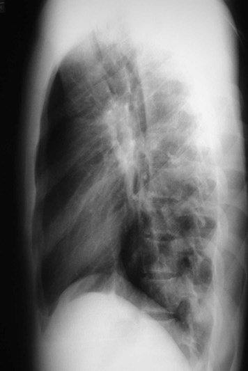 pneumonia behind diaph lat long